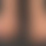 Thrombangiitis obliterans. 52-year-old patient with decades of nicotine abuse. 6 months of acrozy...