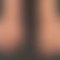 Thrombangiitis obliterans.&nbsp;52 Jahre alter Patient mit jahrzehntelangem Nikotinabusus.&nbsp;S...