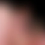 Thrombangiitis obliterans. 32-year-old patient with a nicotine abuse lasting for years and spotte...
