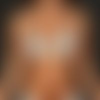 Scleroderma (overview): circumscribed scleroderma as an acquired, cutaneous chessboard-like mosai...