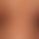 Scleroderma, circumscribed. generalized CS. blurred, clearly indurated, light brown, firm plaques...