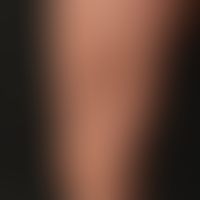 Circumscript scleroderma: Type III profound circumscript scleroderma, deep tissue loss of subcuta...