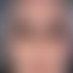 Scleroderma, systemic. tense facial skin, numerous telangiectasias, conspicuous microstomy, pouch...