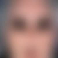 Scleroderma, systemic: taut facial skin, numerous telangiectasias, conspicuous microstomy, pouch ...