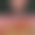 Scleroderma systemic: enormously widened (marked with a black bar) sclerosed cuticle with megacap...
