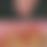 Scleroderma systemic: enormously widened (marked with a black bar) sclerosed cuticle with megacap...