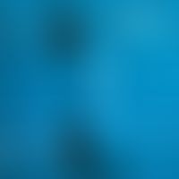 Scleroderma, systemic. nail fold capillaroscopy, irregularly configured capillaries, chimney-shap...