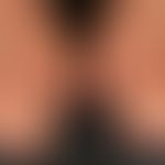 scleroderma systemic: oedematous swelling of the hands and fingers. when stretching the fingers, ...