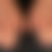 scleroderma systemic: oedematous swelling of the hands and fingers. when stretching the fingers, ...