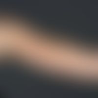 Sklerodermie bandförmige: breite, nur stellenweise indurierte, symptomlose Bänder. &nbsp;&nbsp;
