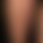 Sklerodermie lineare: offenbar den Blaschko-Linien folgende lineare Morphea. &nbsp;
