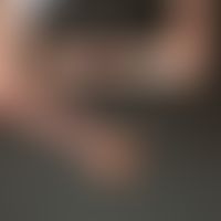 Pansklerotische zirkumskripte Sklerodermie:&nbsp;Pansklerotische, mutilierende Form bei einem 15-...