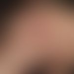 Sklerodermie en coup de sabre: Detailaufnahme. Inflammatorische&nbsp;leicht eingeunkene streifenf...