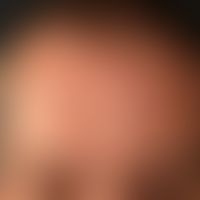 Scleroderma circumscripts (linear scleroderma of the type scleroderma en coup de sabre). 37-year-...
