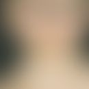 Parry-Romberg-Syndrom:&nbsp;Halbseitige Atrophie von Haut, Fettgewebe und Muskulatur des Gesichts...