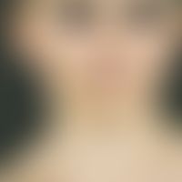 Parry-Romberg-Syndrom:&nbsp;Halbseitige Atrophie von Haut, Fettgewebe und Muskulatur des Gesichts...
