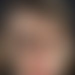 Parry-Romberg-Syndrom:&nbsp; Verlaufsdokumentation, Bild 3: Neurologische (Fazialparese) und opht...