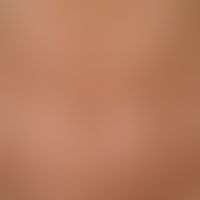 Generalized circumscribed scleroderma: large-area evenly indurated sclerosis of the skin, skin wi...