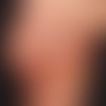 Atrophodermia idiopathica et progressiva: Large, red, confluent, barely palpable, smooth, sharply...