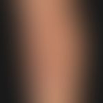 Atrophodermia idiopathica et progressiva. chronic stationary, map-like spread, brownish spots. th...