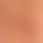 Atrophodermia idiopathica et progressiva. detail section: Chronic stationary, map-like spread, br...