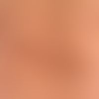 Atrophodermia idiopathica et progressiva. detail section: Chronic stationary, map-like spread, br...