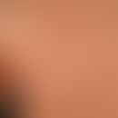 Morphea type or plaque type of circumscribed scleroderma: slightly idurated irregularly bordered ...