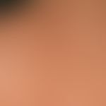 Solar lentignes: multiple, sharply defined stains of varying intensity in the area of the shoulde...
