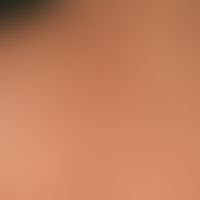 Solar lentignes: multiple, sharply defined stains of varying intensity in the area of the shoulde...