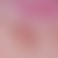 Splitterblutung: Auflichtmikroskopisches Bild mit einer wenige Tage alten Splitterblutung.
