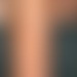 Chronische aktinische Schädigung der Haut. Flächige Atrophie der Haut mit Hyper- und Depigmentier...