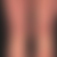 Scleromyxoedema. 52-year-old patient. Increasing, moderately itchy skin lesions for 5 years. Legs...