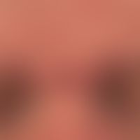 Scleromyxedema. 52-year-old patient shows a diffuse thickening and discreet reddening of the faci...