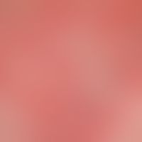Schuppen, groblamelläre: skarlatiniforme (exfoliative) sehr oberflächliche (damit häutchenartige)...