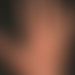 Schuppung: festhaftende (ichthyosiforme) rhomboidal gebrochene, trockene&nbsp;Schupppung bei ausg...