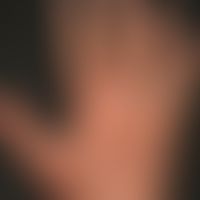 Schuppung: festhaftende (ichthyosiforme) rhomboidal gebrochene, trockene&nbsp;Schupppung bei ausg...