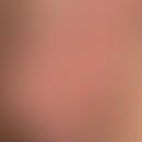 Epidermalzysten am Skrotum (Sebocystomatosis scroti): Bei dem 41-jährigen Mann bestehen seit Jahr...