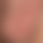 Epidermalzysten am Skrotum (Sebocystomatosis scroti): Bei dem 41-jährigen Mann bestehen seit Jahr...