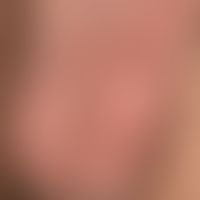 Epidermal cysts at the scrotum (Sebocystomatosis scroti): In the 41-year-old man these, symptomle...
