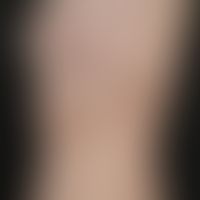 unilateral circumscribed scleroderma: unilateral "segmental" circumscribed scleroderma. the light...