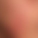 Dermatosis, acute febrile neutrophils: Detail. 36-year-old woman with these acutely occurring, mu...