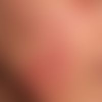 Dermatosis, acute febrile neutrophils: Detail. 36-year-old woman with these acutely occurring, mu...