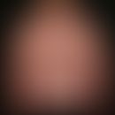 Striae cutis distensae. Frische (rote), symmetrische&nbsp;Striae nach langjähriger interner und l...