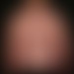 Striae cutis distensae. Frische (rote), symmetrische&nbsp;Striae nach langjähriger interner und l...