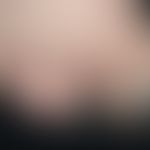 Scleroderma systemic necroses Toes_re_3.jpg