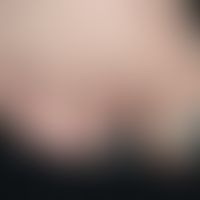 Scleroderma systemic necroses Toes_re_3.jpg
