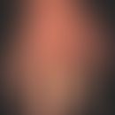 Raynaud's phenomenon in known systemic scleroderma: edematous swelling of the hands and fingers. ...