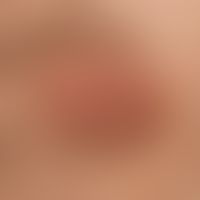 Steatocystoma multiplex: Befall der Areolae mamillae
