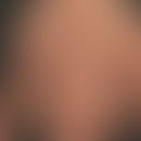 Schnitzler Syndrom: erhebliches Krankheitsgefühl mit rezidivierenden Fieberschüben, juckendem urt...