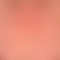 Anular sarcoidosis: anular or circulatory chronic sarcoidosis of the skin. existing for several y...